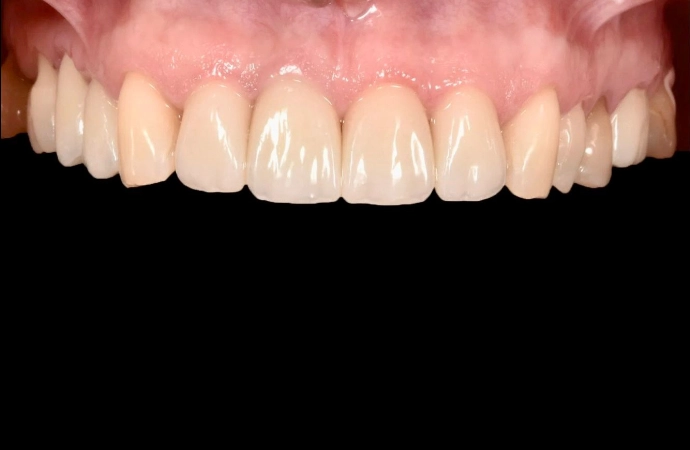 estetică dentară rezultat natural