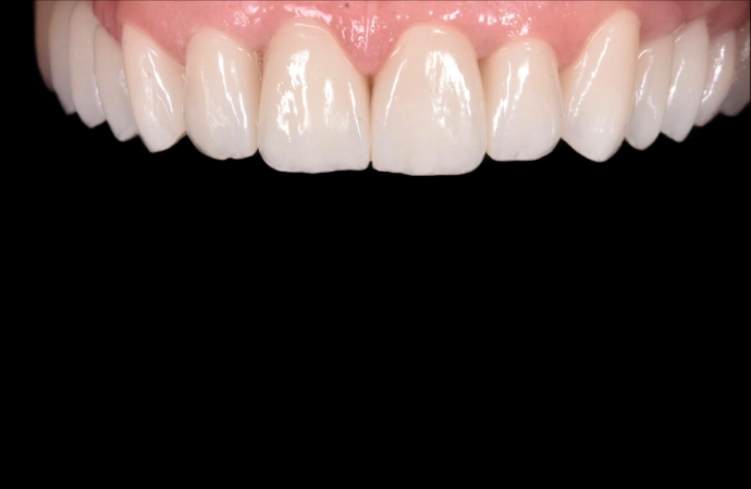 estetică dentară rezultat natural