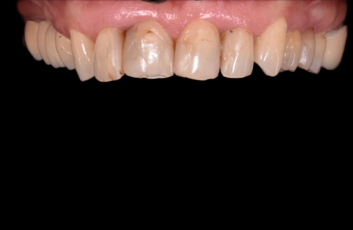 estetică dentară rezultat natural