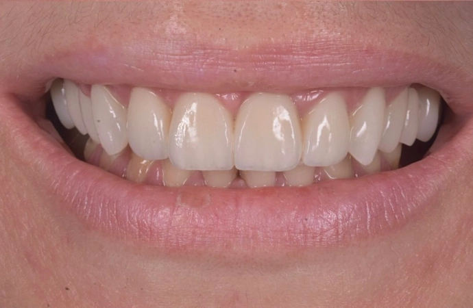 estetică dentară rezultat natural
