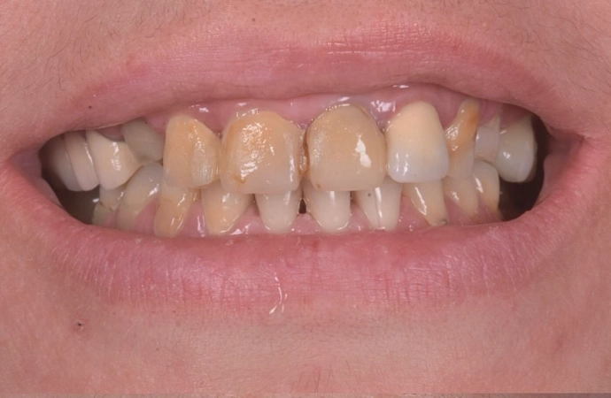 estetică dentară rezultat natural