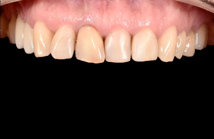 estetică dentară rezultat natural